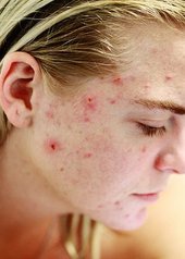 acne adulto