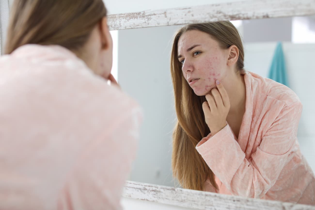 acne hormonal
