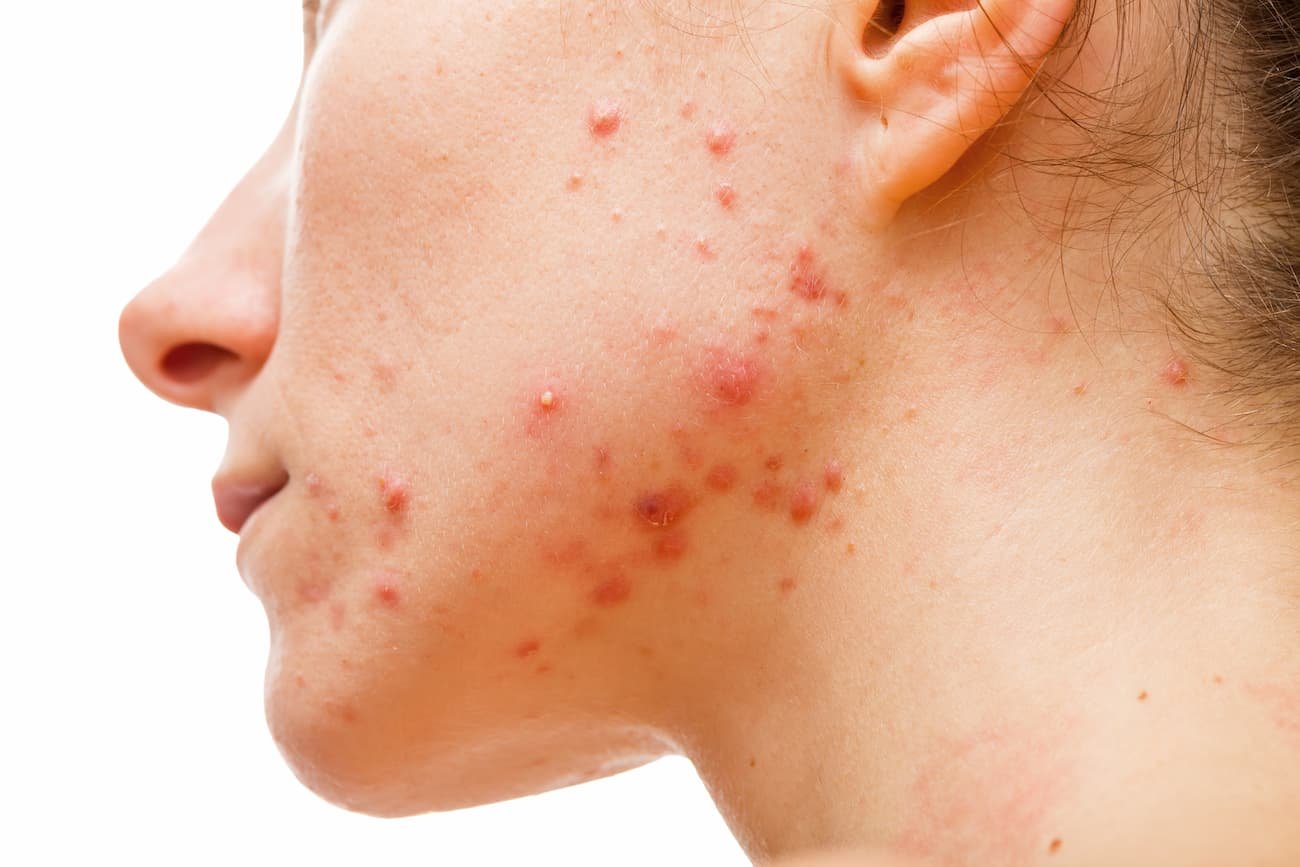 acnes hormonais