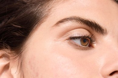 ha-uma-relacao-entre-lacticinios-e-as-imperfeicoes