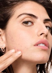 o-que-e-a-acne-hormonal-e-de-que-forma-e-que-uma-rotina-de-cuidados-da-pele-pode-ajudar