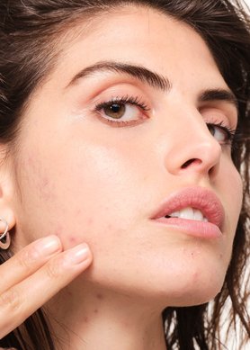 sera-que-os-alimentos-podem-causar-acne