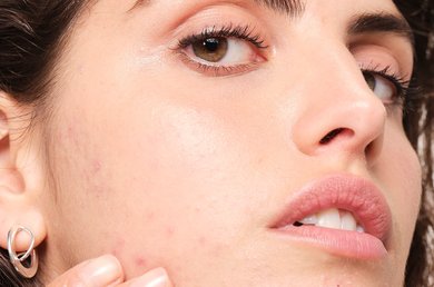 sera-que-os-alimentos-podem-causar-acne