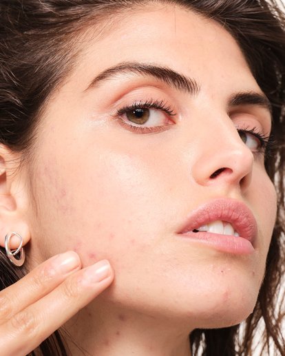 sera-que-os-alimentos-podem-causar-acne