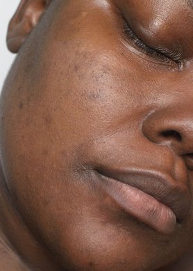hiperpigmentacao pos inflamatoria