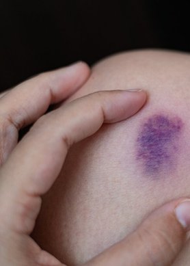manchas roxas na pele