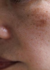 melasma no rosto