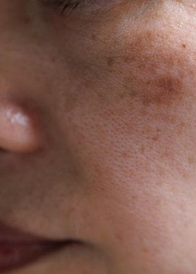 melasma no rosto