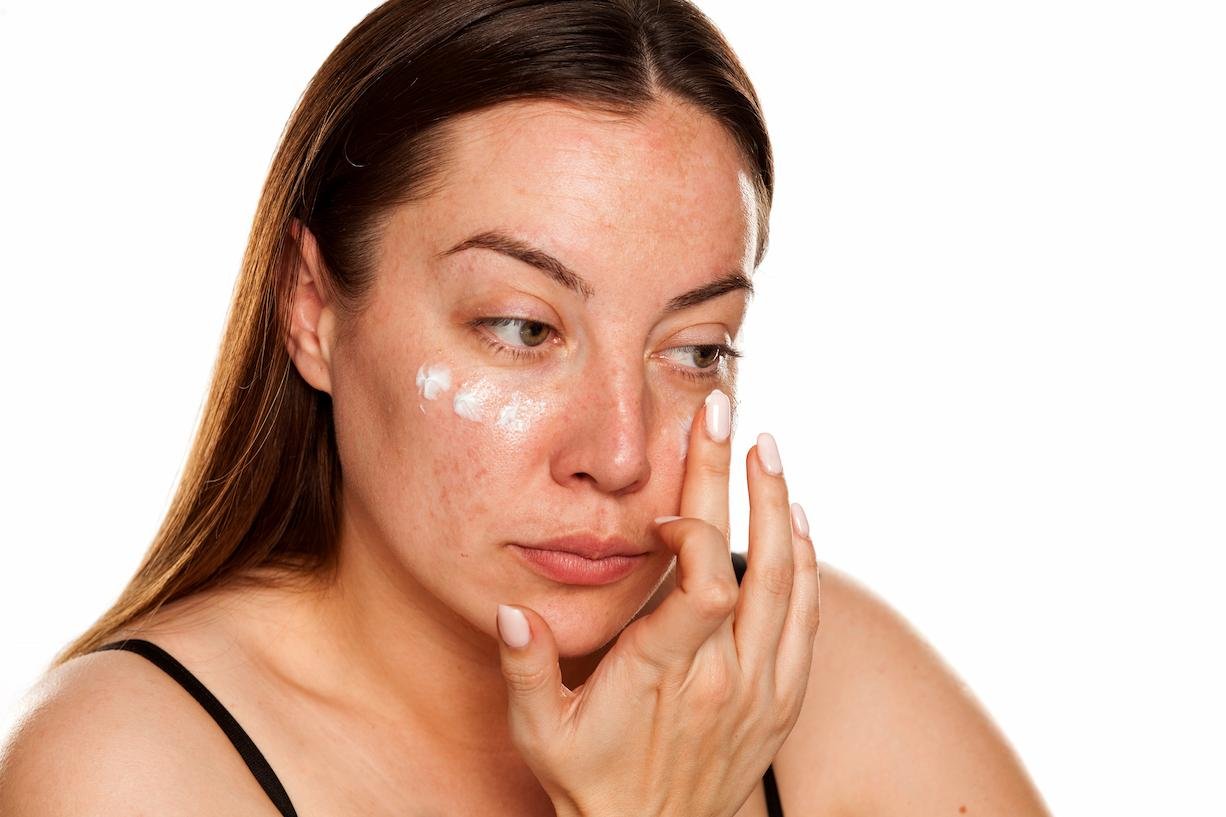 melasma tratamento