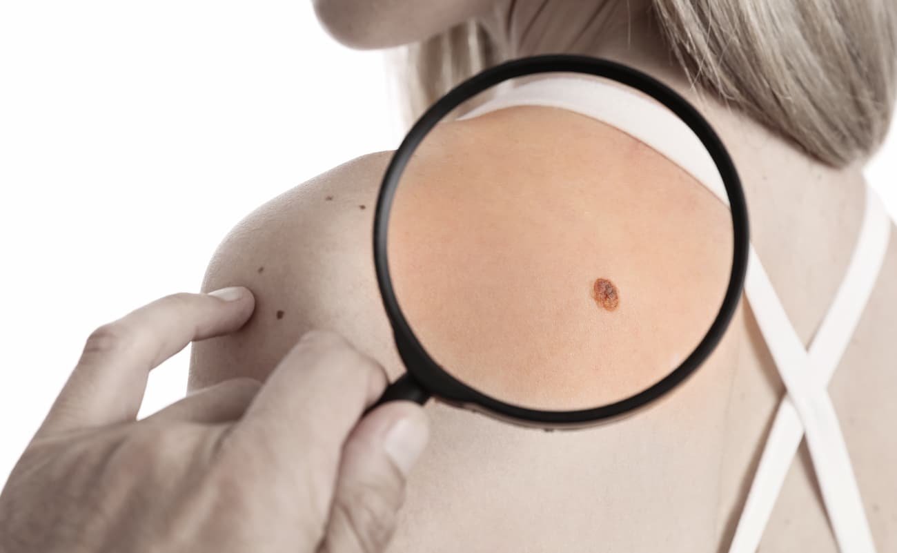 queratose seborreica