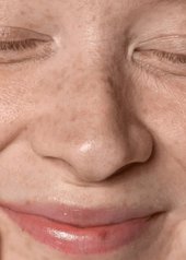 melasma tratamento