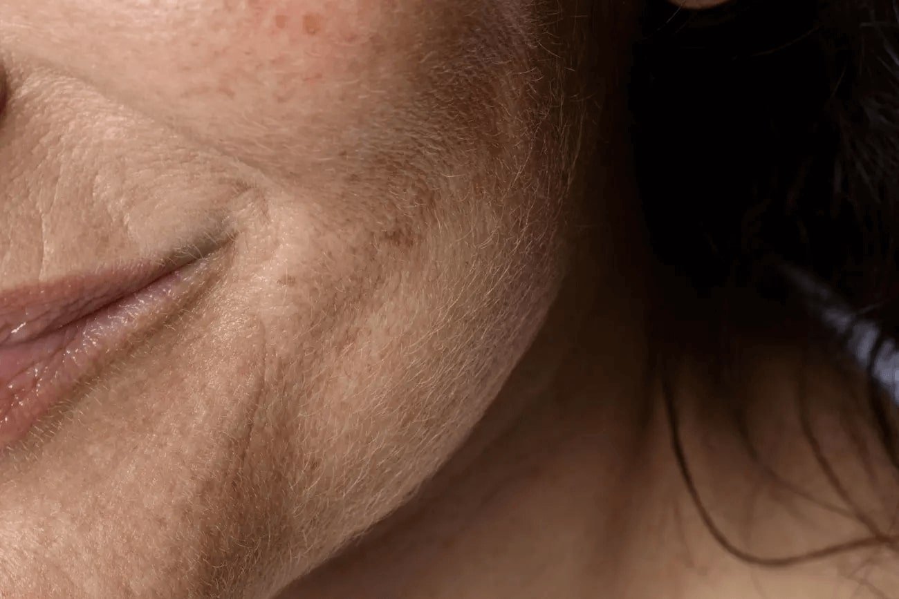cremes para melasma